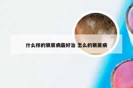什么樣的銀屑病最好治 怎么的銀屑病